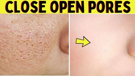 In this video, I will tell you how to close open pores on face permanently naturally at home. In just 3 days you can fill open pores on your face. These are several ways to shrink large pores on the face but natural home remedies have no side effect on your skin. For this reason, I'll highly recommend you to try natural home remedies to reduce open pores on your face. Remedies For Open Pores On Face, Reduce Open Pores On Face, How To Close Pores On Face, How To Remove Open Pores On Face, How To Close Open Pores On Face, How To Close Pores, How To Remove Pores, Open Pores On Face, Pores On Face