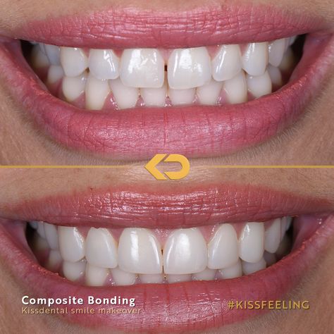 Edge Bonding Teeth Before And After, Composite Edge Bonding Teeth, Cosmetic Bonding Teeth, Crown And Bridge Dental Teeth, Snap On Dentures Uk, Composite Bonding, Composite Veneers, 2024 Manifestations, Alderley Edge