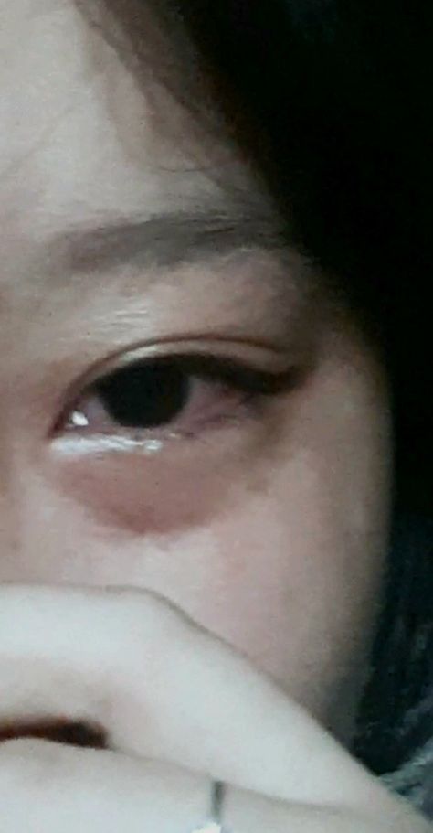 Pap Mata Bengkak, Fever Aesthetic Sick, Cry Eye, Sharpen Wallpaper, Crying Eyes, Crying Face, Anime Smile, Pap Random, Real Pic