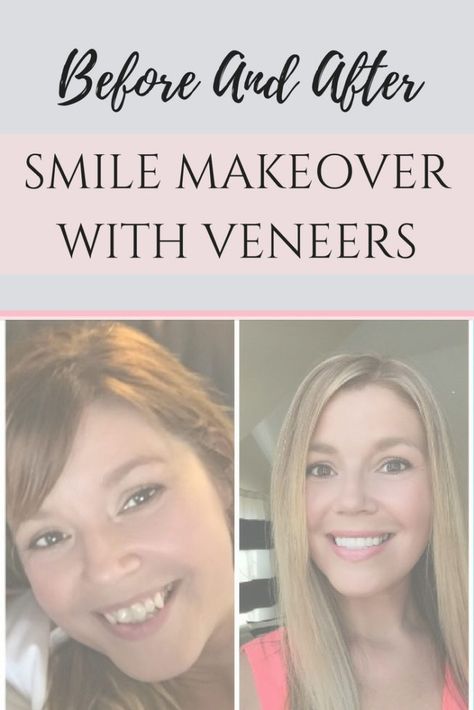 Cosmetic Dentistry Before And After, Dental Veneers Before And After, Veneers Before And After, Celebrity Teeth, Story Review, Straight Smile, Veneers Teeth, Makeover Before And After, Dental Veneers