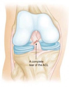 Acl Knee Brace, Acl Brace, Knee Ligament Injury, Acl Knee, Hip Brace, Orthopedic Brace, Knee Ligaments, Acl Surgery, Anterior Cruciate Ligament