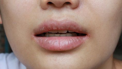 Cracked Lip Corners, Cracked Corners Of Mouth, Mouth Breather, Antifungal Cream, Cracked Lips, Skin Healing, Your Lips, Teeth Cleaning, How To Apply Makeup