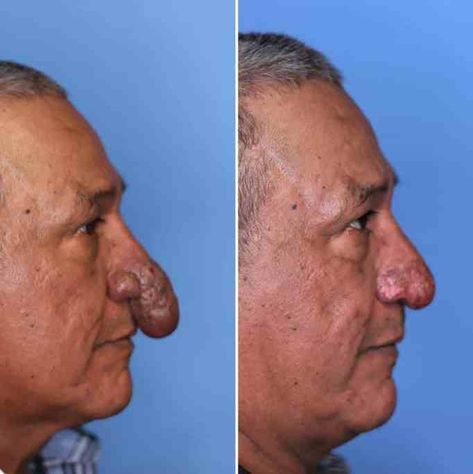 House painter given life-changing nose surgery as a gift by surgeon whose house he was working on Wide Nose Surgery, Nose Change Without Surgery, Rhinoplasty Before After Wide Nose Jobs, Rynoplasty Surgery, Kyphoplasty Surgery, Air Conditioner Units, Positive Stories, Nose Surgery, Skin Specialist