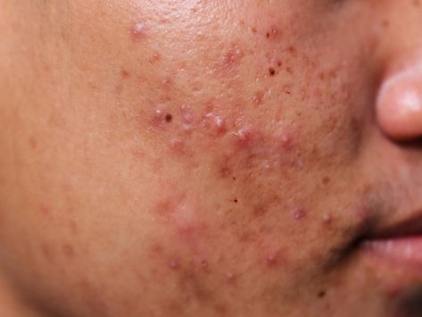 These powerful close-up photos of acne will change the way you think about your skin Acne Photos, Back Acne Remedies, Blind Pimple, Forehead Acne, Prevent Pimples, Pimples Under The Skin, How To Remove Pimples, Natural Acne Remedies, Skin Photo