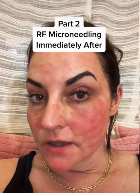 Immediatly after getting RF Microneedling done with the Venus Viva Rf Microneedling Before And After, Rf Microneedling, Day By Day, Makeup Skin Care, Skin Makeup, Skin Care, Skin, Makeup, Make Up