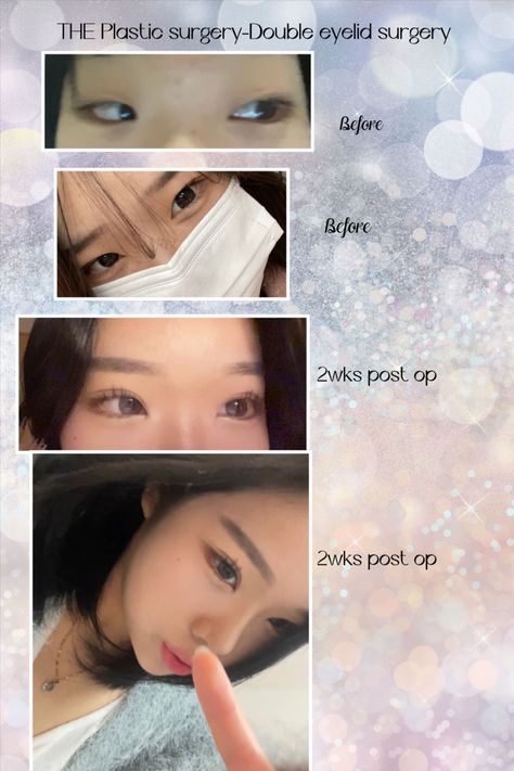 Beauty Surgery, Celebrity Surgery, Double Eyelids, Korean Plastic Surgery, Powerpoint Slide Designs, Online Consultation, Celebrities Then And Now, Double Eyelid, Before After Photo