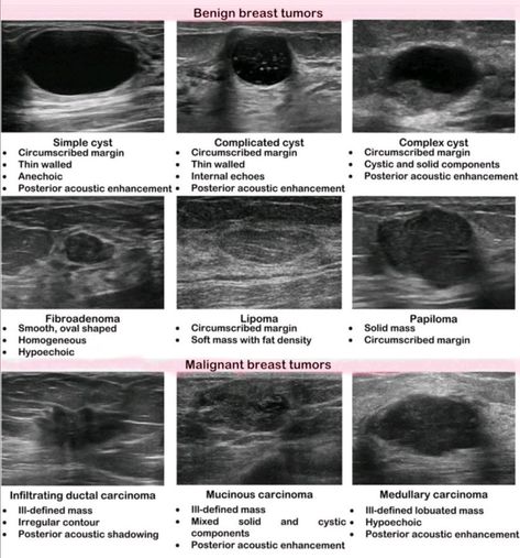 Ultrasound Abdomen Boards, Breast Ultrasound Image, Diagnostic Medical Sonography Student Notes, Ultrasound Tech Notes, Sonography Notes, Sonography Student Study, Diagnostic Medical Sonography Student, Ultrasound School, Ultrasound Physics