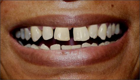 Teeth. Unusually large spaces between teeth. Space Between Teeth, Theatrical Makeup, How To Look Better, Makeup, Make Up