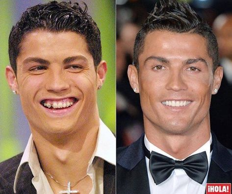 Christiano Ronaldo smile makeover - how the smile changes the outlook After Braces, Dental Advertising, Plastic Surgery Gone Wrong, Face Surgery, Kesehatan Gigi, Veneers Teeth, Dental Braces, Teeth Straightening, Teeth Braces