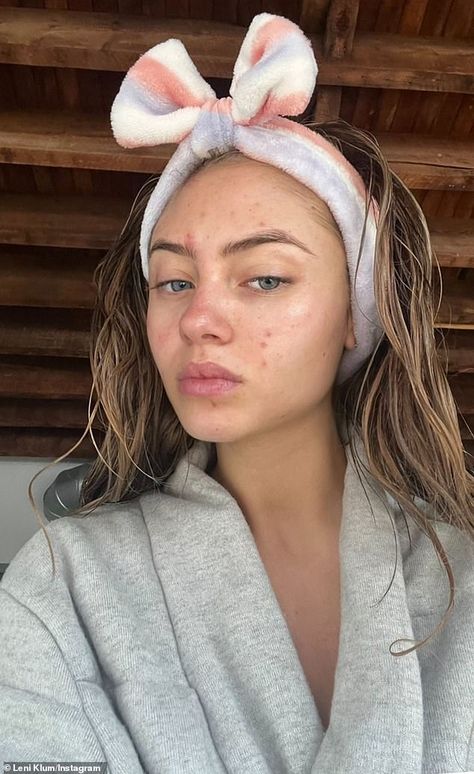 Normalizing Insecurities, Pretty People With Acne, Acne Appreciation, Acne Pretty, Acne Model, Strawberry Freckles, Acne Aesthetic, Acne Journey, Girl With Acne