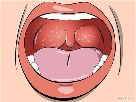 How to Tell if You Have Strep Throat Strep Throat Pictures, Healthy Book, Throat Infection, Strep Throat, Dark Underarms, Health Signs, Health And Fitness Magazine, Migraine Headaches, Bacterial Infection