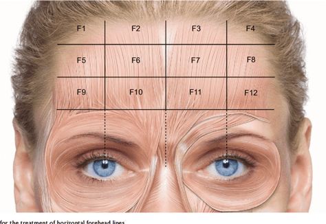 [PDF] Tailored botulinum toxin type A injections in aesthetic medicine: consensus panel recommendations for treating the forehead based on individual facial anatomy and muscle tone | Semantic Scholar Botox Injection Sites, Injection Sites, Botox Injection, Eyebrow Lift, Facial Anatomy, Botox Cosmetic, Botulinum Toxin, Botox Face, Face Anatomy