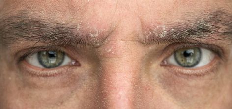 Eyebrow dandruff is flaky skin that sheds from the eyebrows. There are several possible culprits, which we detail in this article. Eyebrow Dandruff, Dandruff Flakes, Aloe Vera Benefits, Flaking Skin, Dry Flaky Skin, Scaly Skin, Inflammation Causes, Skin Disorders, Flaky Skin