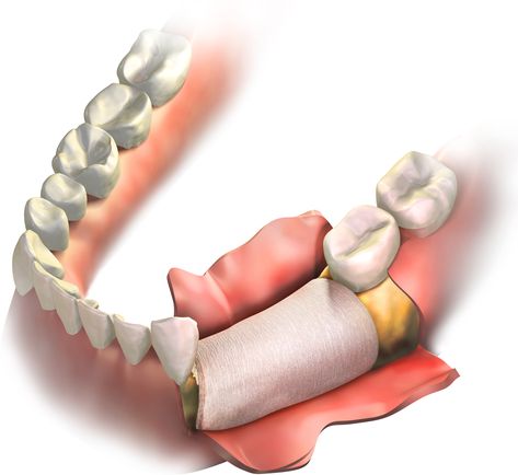 Bone grafting may be a necessary part of the implant process to prepare the jawbone for surgery, and here’s why you may need one in Woodbridge #bonegraft #implant #dentist Bone Grafting Teeth, Dental Logos, Preparing For Surgery, Tooth Infection, Dental Implant Procedure, Implant Dentist, Bone Grafting, Columbia Maryland, Dental Implant Surgery