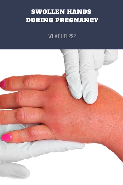 Fluid Retention Remedies, Swollen Feet Pregnancy, Swelling Remedies, Pregnancy Swelling, Swollen Hands, Itchy Hands, Pregnancy Remedies, Numbness In Hands, Sore Hands