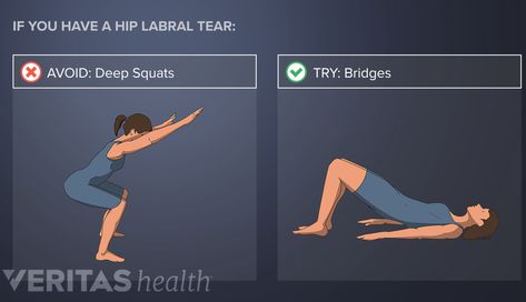 6 Activities to Avoid with a Hip Labral Tear | Sports-health Labral Tear Hip, Hip Labral Tear, Wrist Pain Relief, Single Leg Bridge, It Band Stretches, Bridge Workout, Daily Chores, Hip Flexor Stretch, Deep Squat