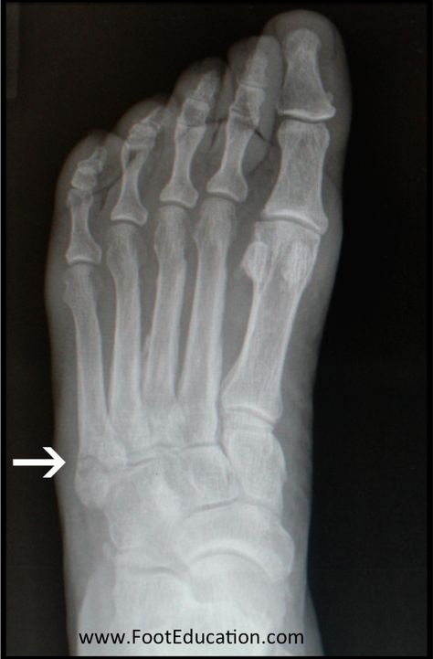 Jones Fracture - FootEducation Jones Fracture, Metatarsal Fracture, Avulsion Fracture, Types Of Fractures, Fracture Healing, Ankle Ligaments, Bone Healing, Broken Foot, Body Makeover