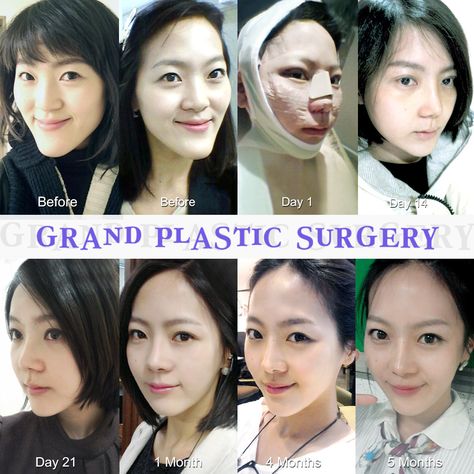 Create a slender jaw line and youthful appearance with Grand. Grand's two jaw surgery enables you become beautiful in a safe way. For free consultation Tel: (+82) 70-7119-1580 Mobile: (+82) 10-7156-6546(Whatsapp, Line, Kakaotalk, Viber, iMessage) Email: grandps.en@gmail.com Facebook: facebook.com/grandplasticsurgery Webstie: eng.grandsurgery.com Pinterest : https://www.pinterest.co.kr/grandps_eng/ Tumblr: http://grandsurgery.tumblr.com/ Instagram: grandps_eng Chin Reduction Surgery, Long Chin, Chin Surgery, Chin Reduction, Plastic Surgery Korea, Bad Plastic Surgeries, Korean Plastic Surgery, Become Beautiful, Jaw Surgery