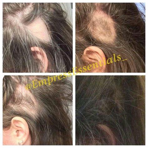 Chemistry Hacks, Hair Growth Cream, Hair Growth Rate, Hair Edges, Hair Regrowth Women, Grow Thicker Hair, Thicker Healthier Hair, Sweet Hairstyles, Dunner Wordend Haar