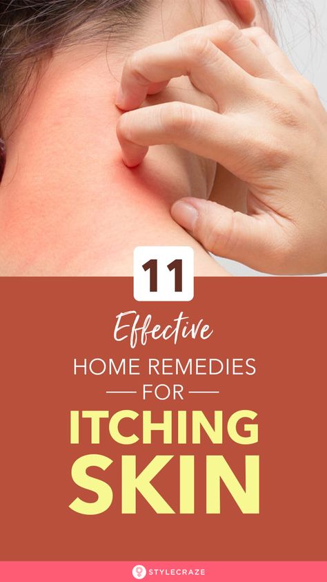 Itching Skin Remedies, Dry Itchy Skin Remedies, Skin Rash Remedies, Itchy Body, Itching Remedies, Itch Relief Skin, Itchy Skin Rash, Itchy Skin Remedy, Itchy Skin Relief