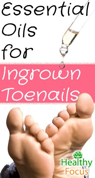 How to Get Rid of an Ingrown Toenail - Healthy Focus Angular Cheilitis, Essential Oils For Face, Coconut Oil For Teeth, Coconut Oil For Dogs, Coconut Oil For Acne, Ingrown Toenail, Coconut Oil For Face, Ingrown Nail, Oil Remedies