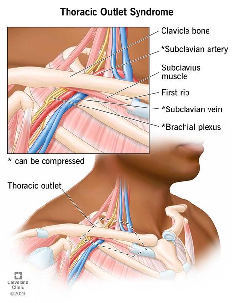 Thoracic outlet syndrome refers to a group of disorders that cause pain and other symptoms in your upper body. Learn the three types of TOS. Nerve Relief, Thoracic Outlet, Subclavian Artery, Neck Problems, Nerve Health, Arteries And Veins, Neck And Shoulder Pain, Ehlers Danlos Syndrome, Emergency Care