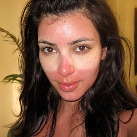 Cute Sunburn Face, Sunburn Aesthetic Face, Sunburn Face Remedy, Face Peeling From Sunburn, How To Treat Sunburn On Face, Sunburn Makeup Look, Cute Sunburn, Sunburn Aesthetic, Sunburned Face