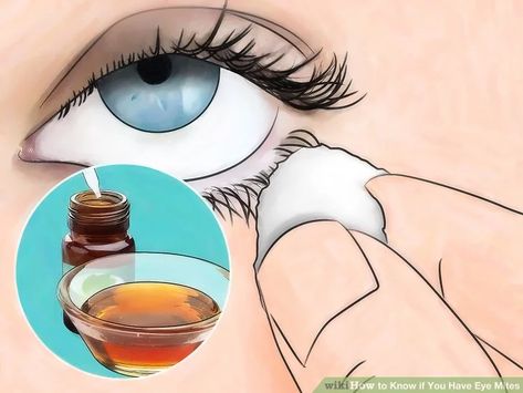 Itchy Eyes Remedy, Eye Mites, Dry Eye Remedies, Itchy Eyelids, Eye Health Remedies, Eye Stye Remedies, Demodex Mites, Allergy Eyes, Tea Tree Oil Shampoo