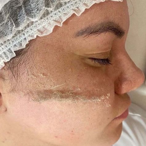 Derma Blading Face, Before And After Dermaplaning, Dermaplaning Pictures, Facials Before And After, Derma Planing Face, How To Dermaplane At Home, Diy Dermaplaning At Home, Dermaplaning Before And After, Derma Planning