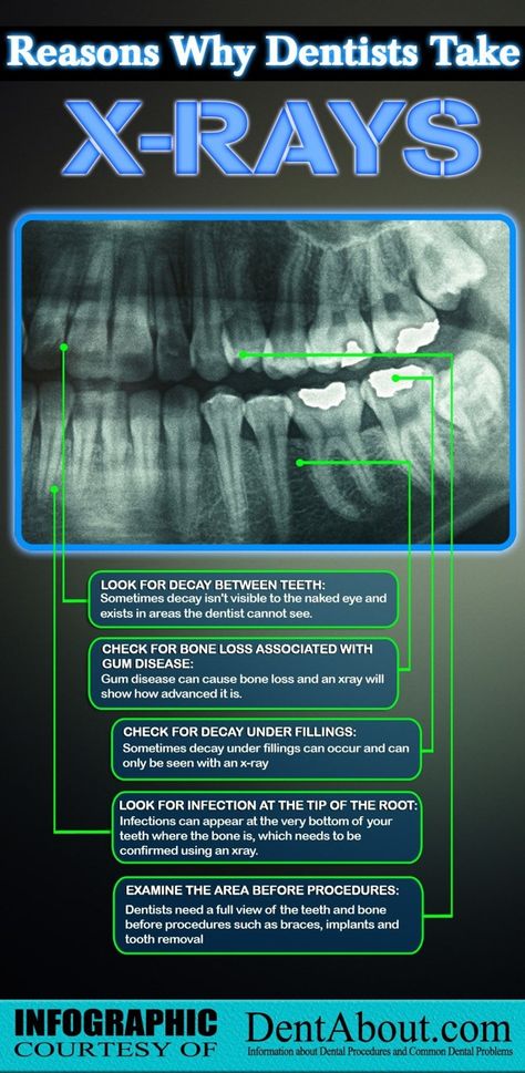 Why dentists take xrays..... Dental Xrays, Dental Assistant Study, Dental World, Kedokteran Gigi, Dental Hygiene School, Dental Fun, Dental Facts, Dental Life, Dental Marketing