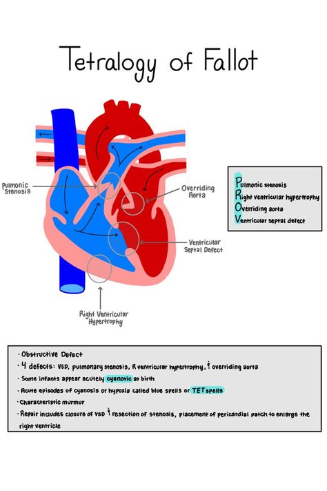 Tetralogy Of Fallot Mnemonic, Pediatric Cardiac Nursing Congenital Heart Defect, Congenital Heart Defect Nursing, Tetralogy Of Fallot Nursing, Dvt Nursing, Nurse Vocabulary, Tetralogy Of Fallot, Respiratory Therapist Student, Pediatric Cardiology