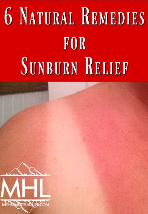 Vinegar For Sunburn, Treating Shingles, Sunburn Blisters, Remedies For Sunburn, Home Remedies For Sunburn, Aloe Vera For Sunburn, Natural Remedies For Sunburn, Bad Sunburn, Sunburn Remedies