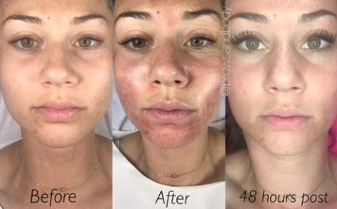 Before And After Microneedling, Microneedling Before And After, Microneedling Benefits, Graceful Aging, Derma Rolling, Peeling Facial, Micro Needling, Beauty Procedures, Derma Pen