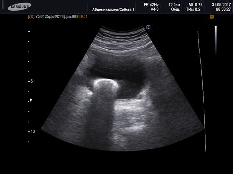 bladder stone Vet Medicine, Ultrasound, Medicine, Stone