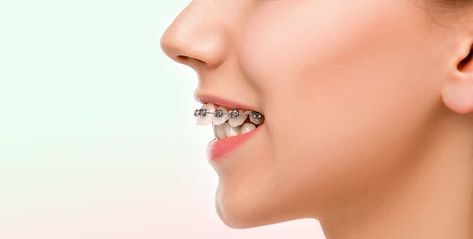 How To Fix Overbite At Home, Overbite Teeth, Fix Overbite, Extra Teeth, Smile Tips, Rotten Teeth, Teeth Remedies, Misaligned Teeth, Buck Teeth