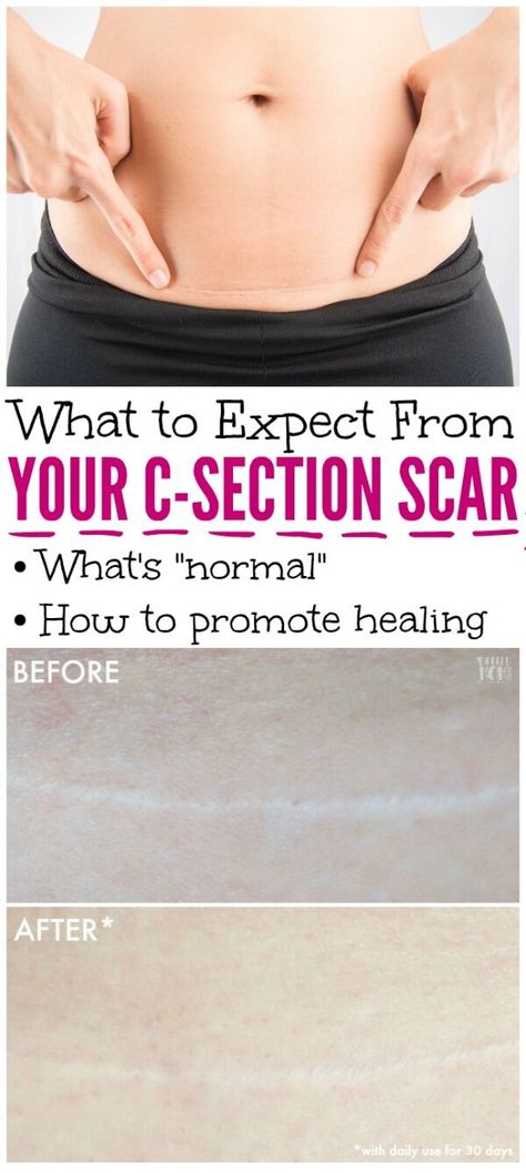 C Section Scar, C Section Scars, C Section Recovery, Scar Cream, Cold Medicine, Home Remedy For Cough, Skin Natural Remedies, Cold Sores Remedies, Natural Sleep Remedies