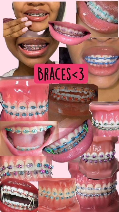 CAROLINA Dental Braces Colors, Braces Colors Combinations, Braces Ideas, Pink Braces, Cute Braces Colors, Pretty Teeth, Braces Tips, Getting Braces, Cute Braces