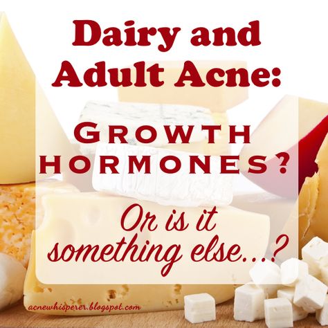 Can Adult Acne breakouts be caused by dairy? Maybe. Find out more on The AcneWhisperer Blog. Breakout Remedies, Kosher Kitchen, Hormonal Breakouts, Bad Acne, Acne Help, Eye Sight Improvement, Acne Causes, Acne Problem, Acne Solutions