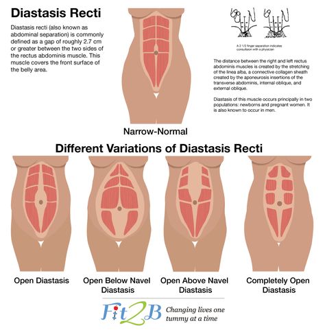 What Is Diastasis Recti, Diástase Abdominal, Rectus Abdominis Muscle, Healing Diastasis Recti, Mummy Tummy, Diastasis Recti Exercises, Post Pregnancy Workout, Wellness Mama, Pregnancy Body