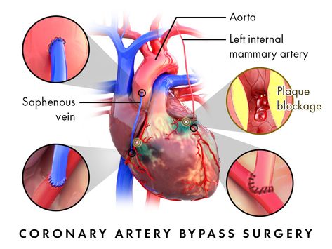 Best Coronary Artery Bypass Grafting in Hyderabad Cardiothoracic Surgeons, Cardiac Assessment, Cardiac Rehabilitation, Coronary Artery, Heart Rhythms, Heart Function, Heart Muscle, Coronary Arteries, Surgery Center