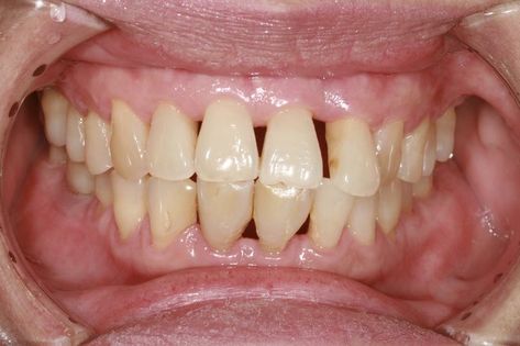 Home Remedies for Periodontal Disease | Livestrong.com Bad Teeth, Emergency Dentist, Pediatric Dentist, Periodontal Disease, General Dentistry, Gum Care, Dental Problems, Medical Health, Dental Hygiene