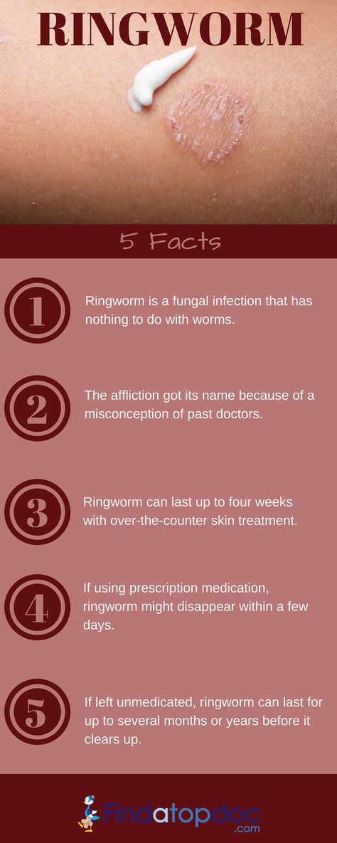 infection is caused by a fungus, not a worm. Ringworm infection can affect both humans and animals Ringworm is a fungal infection of the skin. The name “ringworm” is a misnomer, since the. Ringworms In Humans, Home Remedies For Sinus, Fungal Infection Skin, Natural Remedies For Migraines, Health Chart, Humans And Animals, Dry Skin Remedies, Healthy Lifestyle Quotes, Diy Body Care