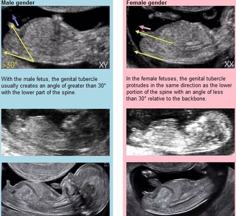 nubtheory | Flickr - Photo Sharing! Baby Gender Ultrasound, Ultrasound Gender, Baby Gender Predictor, Baby Announcing Ideas, Nub Theory, Obstetric Ultrasound, Gender Predictor, Baby Gender Prediction, Gender Prediction