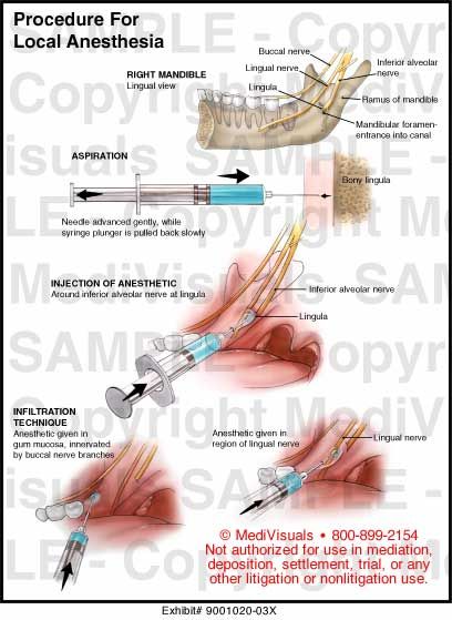 Local anesthesia in dentistry Dental Hygiene Local Anesthesia, Local Anaesthesia In Dentistry, Dental Local Anesthesia, Dental Anesthesia Injection Sites, Local Anesthesia Dental Hygiene, Local Anesthesia Dental, Dental Anesthesia, Dental Assistant School, Local Anesthesia