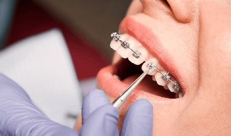 Braces Bowling Green
Braces in Bowling Green Lingual Braces, Braces Cost, Types Of Braces, Adult Braces, Getting Braces, Clear Braces, Braces Colors, Teeth Straightening, Teeth Braces