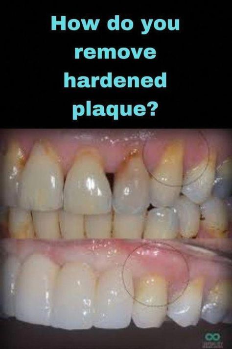 How do you remove Harden Plaque?#cavities #toothdecay #healcavities #healtoothdecay #dental #dentaltrick #healthyteeth #oralhealth #rdh #teeth #dentalhealth #Remedies #HomeRemedies #Health #Wellness #WhyOralCareIsImportant Fix Receding Gums, Plaque Teeth, Heal Cavities, Dental Cavities, Dental Plaque, Tooth Sensitivity, Receding Gums, Oral Care Routine, Oral Health Care