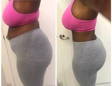 Mia Aesthetics on Instagram: “Before & After so good it deserves to be posted again. . . Procedure: 💉Lipo360 // Brazilian Butt 🍑Lift. Doctor: Dr. Alvarez. Height: 5’4.…” Lipo 360 Before And After Black Women, Brazilian Buttlift Surgery Results, Lipo 360 Before And After, Breast Lift Surgery Before And After, Lipo 360, Tummy Tucks Recovery, Lipo Before And After, Body Surgery, Breast Lift Surgery