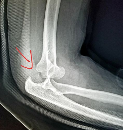 Elbow Xray, Bandra Worli Sea Link, Anatomy Bones, Accident Injury, Disney Princess Aurora, Health Information, Princess Aurora, Radiology, Occupational Therapy