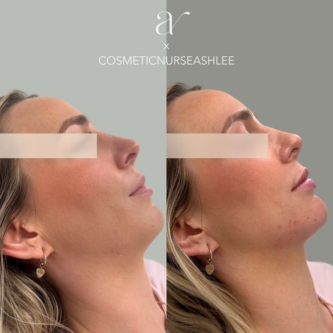 FACIAL BALANCING ✨ Like I said in my story, this before and after could make me cryyy 🥹 Facial balancing is unique and individualised. It could focus on proportions, asymmetries or shadows. We consider the facial shape, it’s curves, angles and how it looks as a whole. Each injectable artist will have priorities unique to their aesthetic eye, as well as preferences on products and techniques. 👩‍🎨 For many people, facial balancing is about the PROFILE or side view. And as you can see here, ... Facial Balancing, Aesthetic Eye, Aesthetic Eyes, My Story, Many People, Side View, I Said, Focus On, Facial