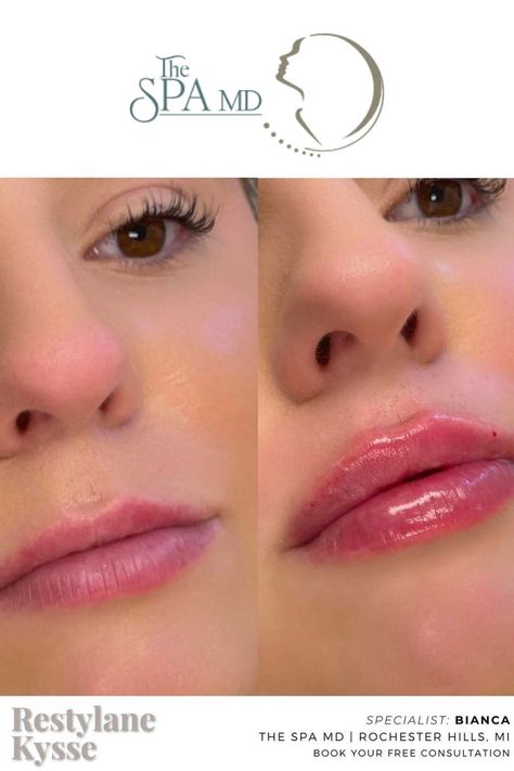 restylane kysse lip filler before and after Restylane Kysse Lips, Botox And Fillers, Hyaluronic Acid Fillers, Cosmetic Injectables, Lip Augmentation, Plump Lips, Injectables Fillers, Lip Fillers, Don't Settle